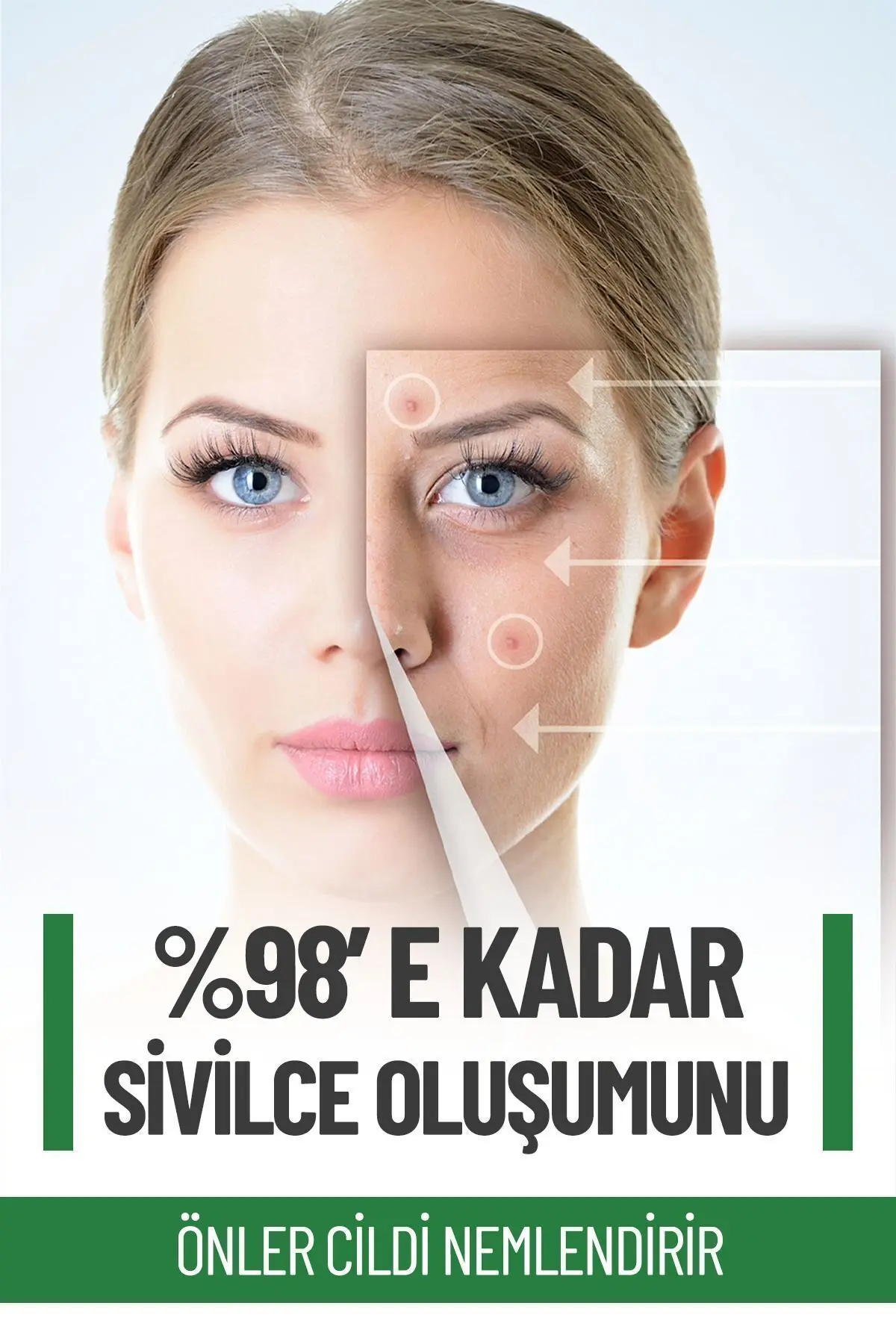 Sivilce Önleyici Ve Sivilce Karşıtı Akne Siyah Nokta Giderici Krem 100 ml
